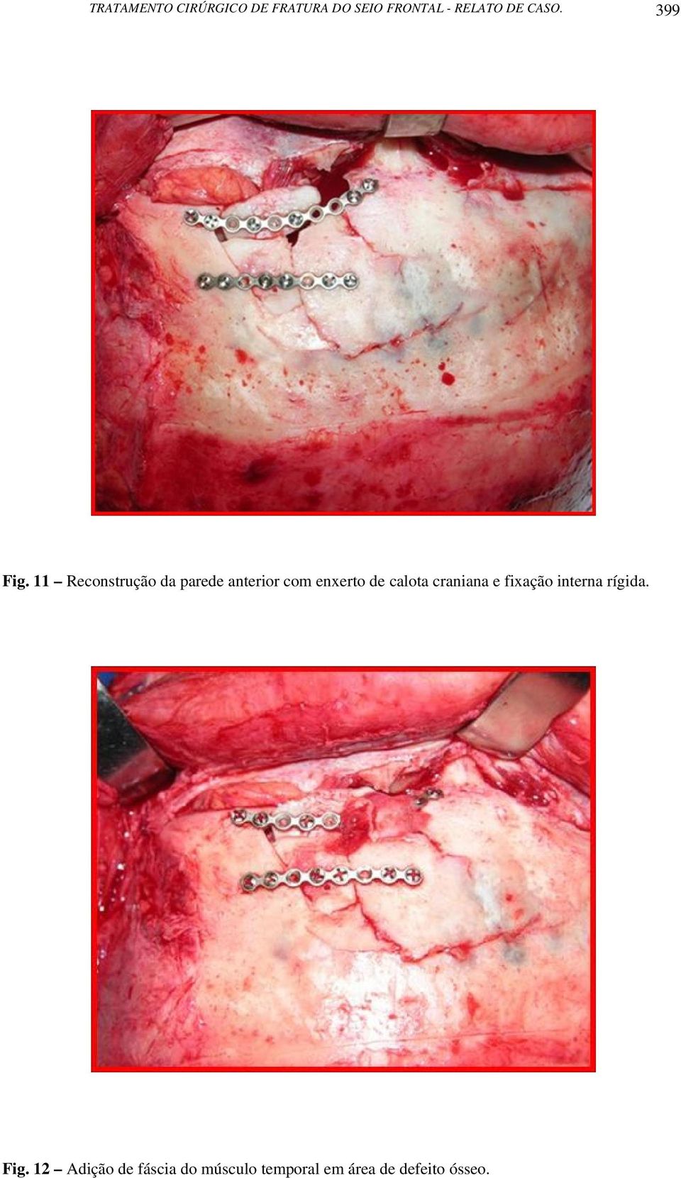 11 Reconstrução da parede anterior com enxerto de calota