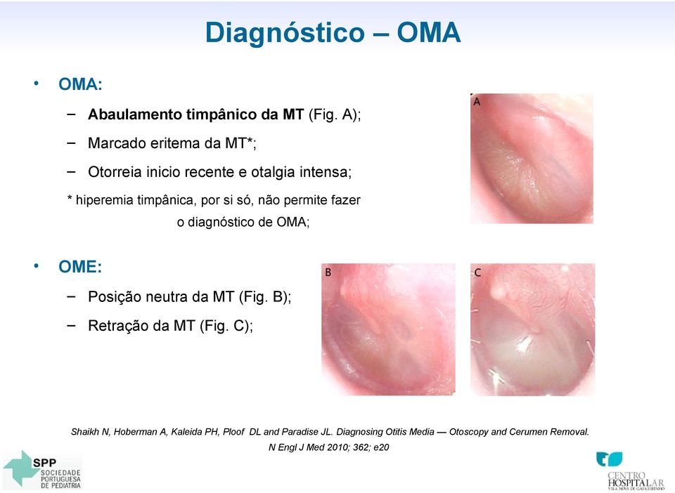 só, não permite fazer o diagnóstico de OMA; OME: Posição neutra da MT (Fig. B); Retração da MT (Fig.