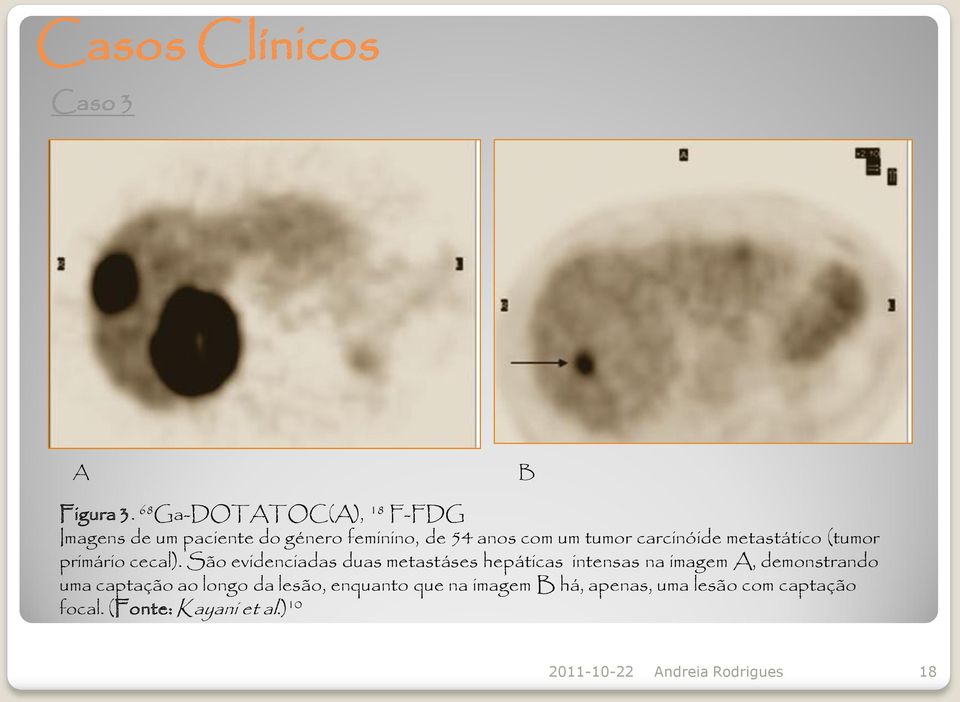 carcinóide metastático (tumor primário cecal).