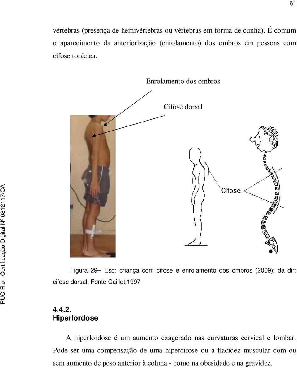 Enrolamento dos ombros Cifose dorsal Figura 29 Esq: criança com cifose e enrolamento dos ombros (2009); da dir: cifose dorsal, Fonte