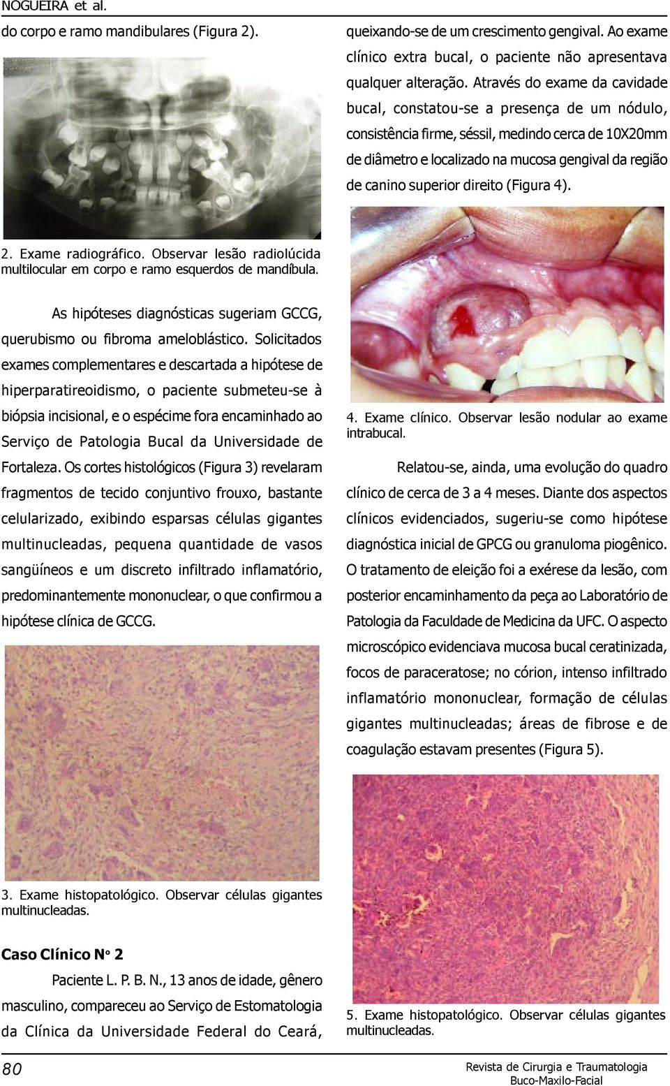 direito (Figura 4). 2. Exame radiográfico. Observar lesão radiolúcida multilocular em corpo e ramo esquerdos de mandíbula. As hipóteses diagnósticas sugeriam GCCG, querubismo ou fibroma ameloblástico.