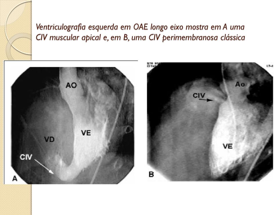 uma CIV muscular apical e, em