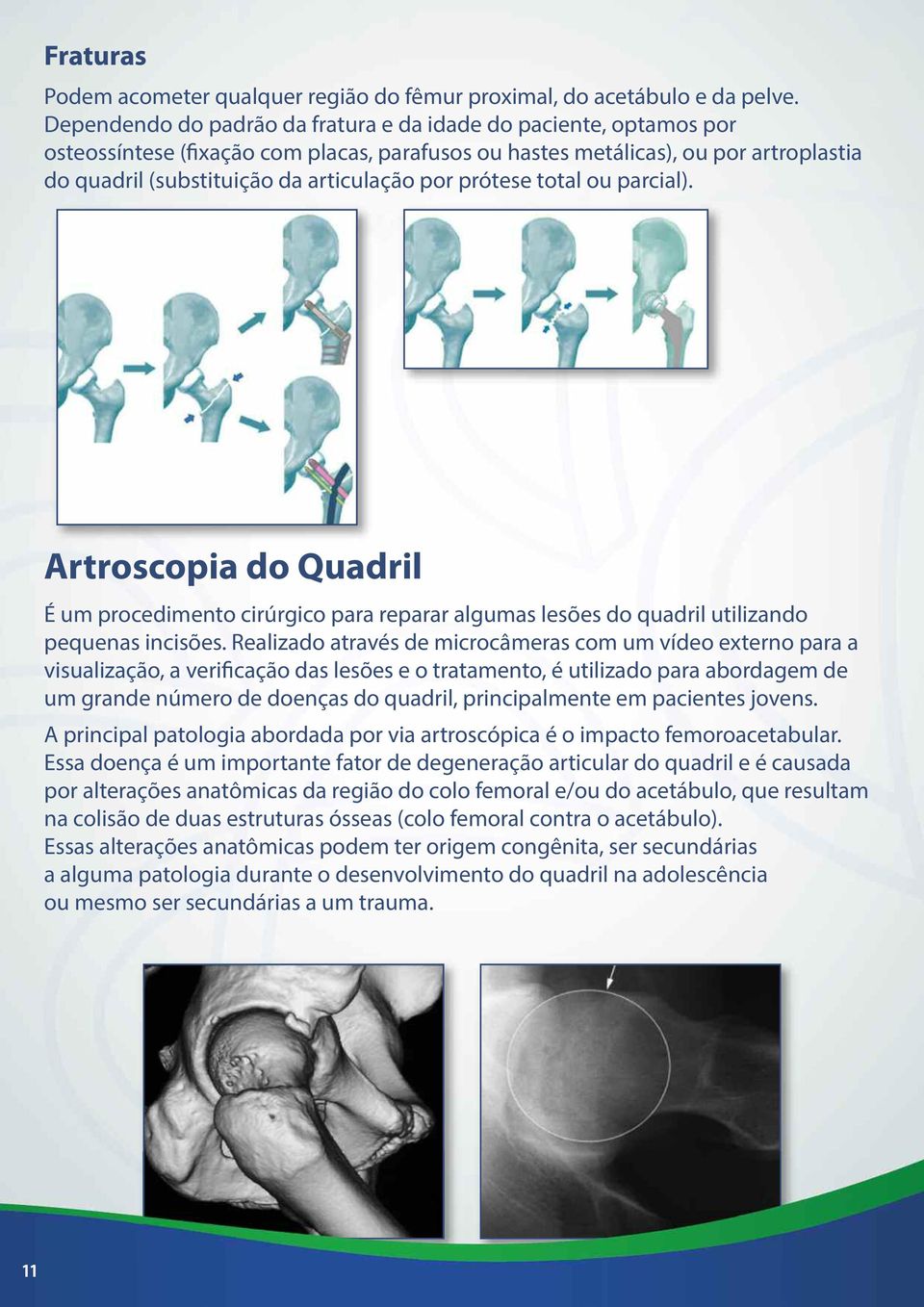 prótese total ou parcial). Artroscopia do Quadril É um procedimento cirúrgico para reparar algumas lesões do quadril utilizando pequenas incisões.