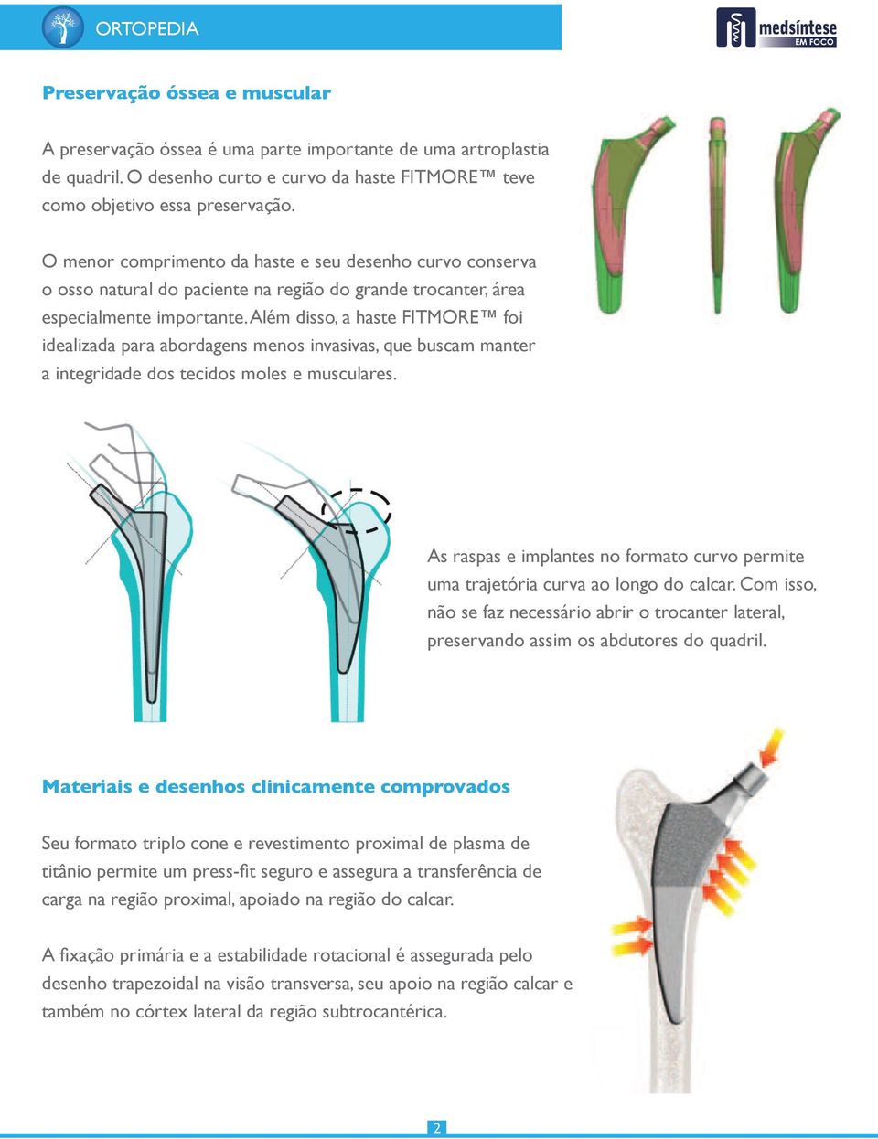 Além disso, a haste FITMORE foi idealizada para abordagens menos invasivas, que buscam manter a integridade dos tecidos moles e musculares.