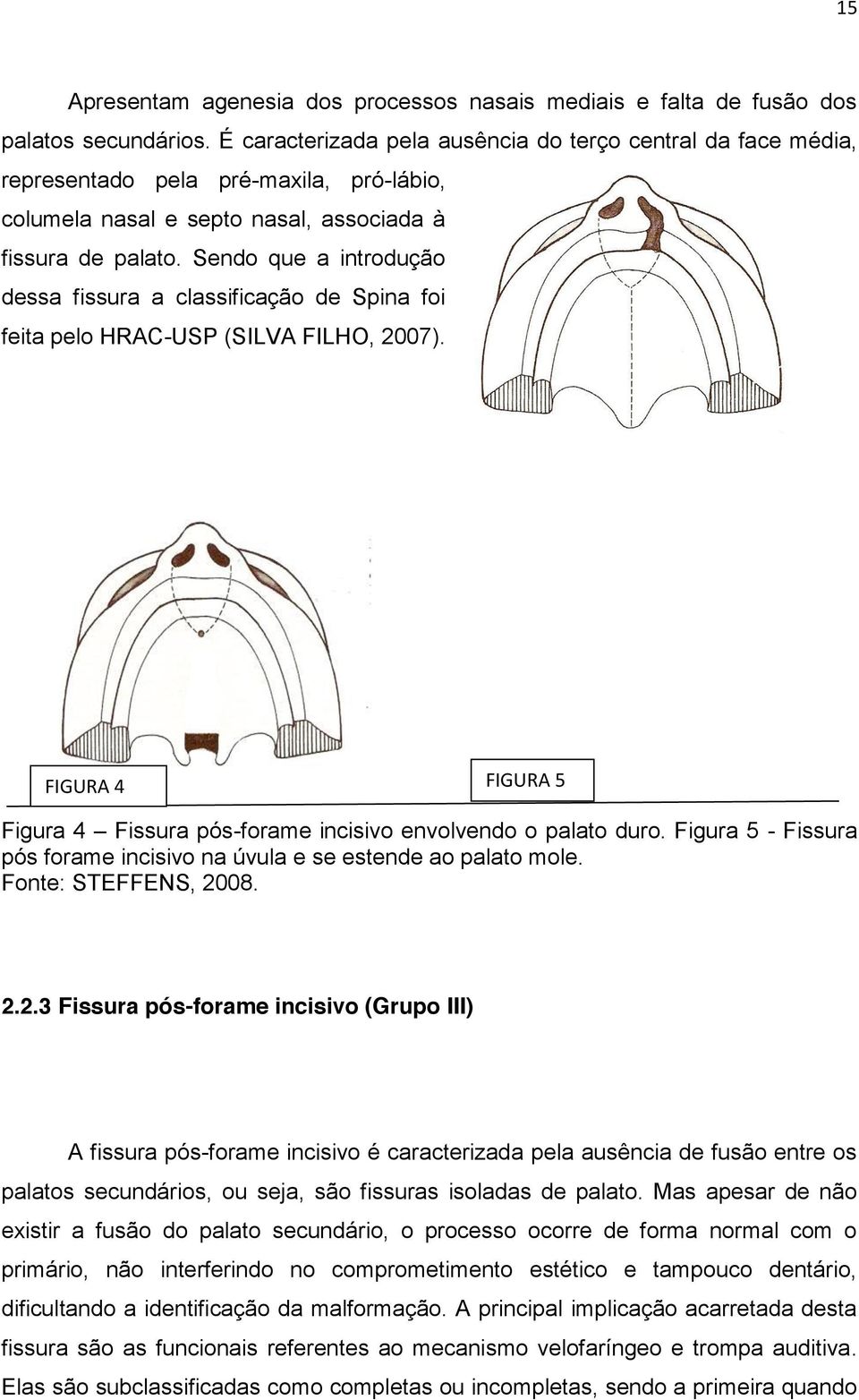 Sendo que a introdução dessa fissura a classificação de Spina foi feita pelo HRAC-USP (SILVA FILHO, 2007). FIGURA 4 FIGURA 5 Figura 4 Fissura pós-forame incisivo envolvendo o palato duro.