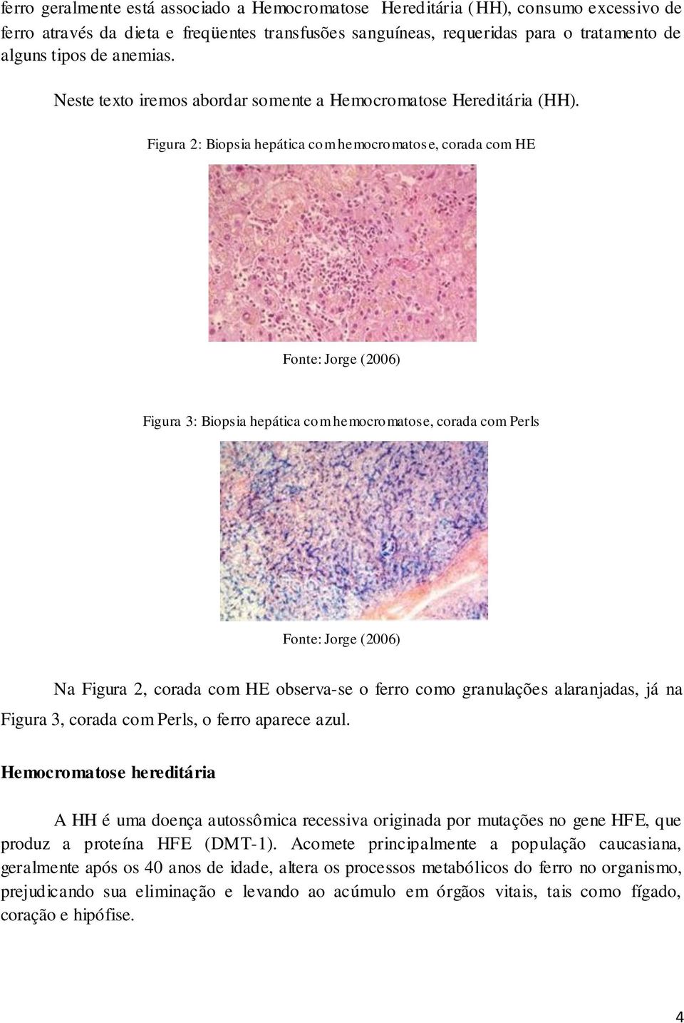 Figura 2: Biopsia hepática com hemocromatose, corada com HE Fonte: Jorge (2006) Figura 3: Biopsia hepática com hemocromatose, corada com Perls Fonte: Jorge (2006) Na Figura 2, corada com HE