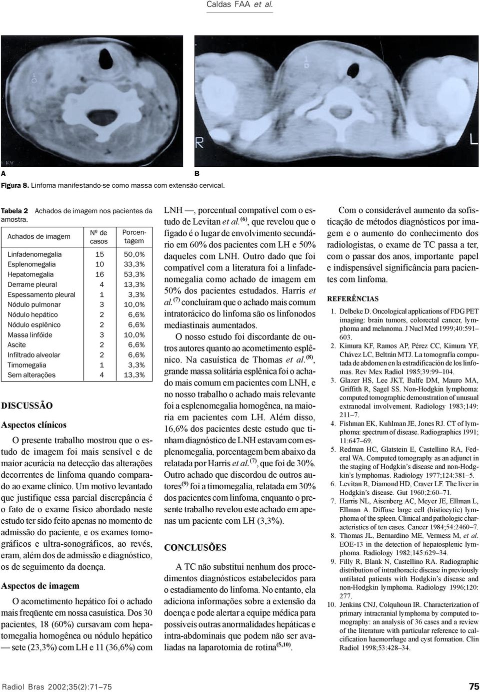 linfóide scite Infiltrado alveolar Timomegalia Sem alterações Nº de casos 5 0 6 4 3 3 4 Porcentagem 50,0% 33,3% 53,3% 3,3% 3,3% 0,0% 0,0% 3,3% 3,3% spectos clínicos O presente trabalho mostrou que o