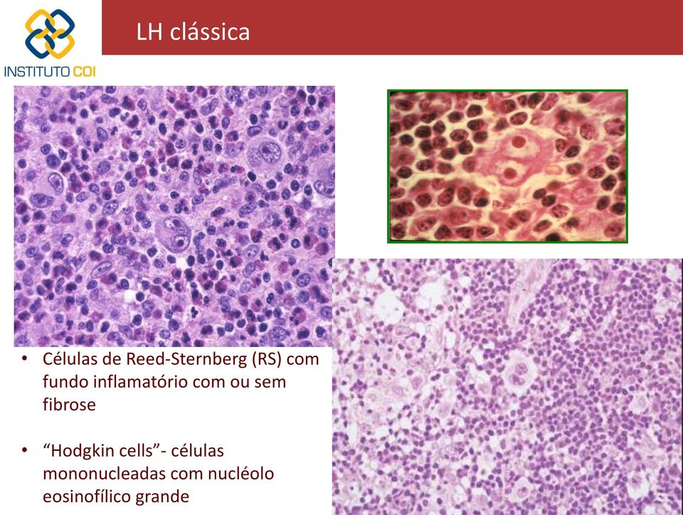 fibrose Hodgkin cells - células