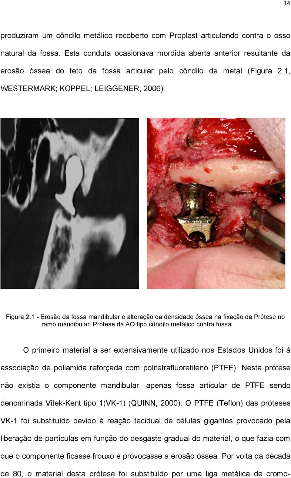 1 - Erosão da fossa mandibular e alteração da densidade óssea na fixação da Prótese no ramo mandibular.