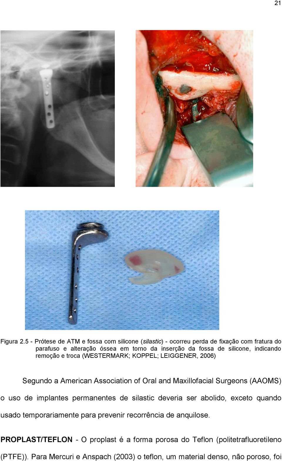 silicone, indicando remoção e troca (WESTERMARK; KOPPEL; LEIGGENER, 2006) Segundo a American Association of Oral and Maxillofacial Surgeons (AAOMS) o uso