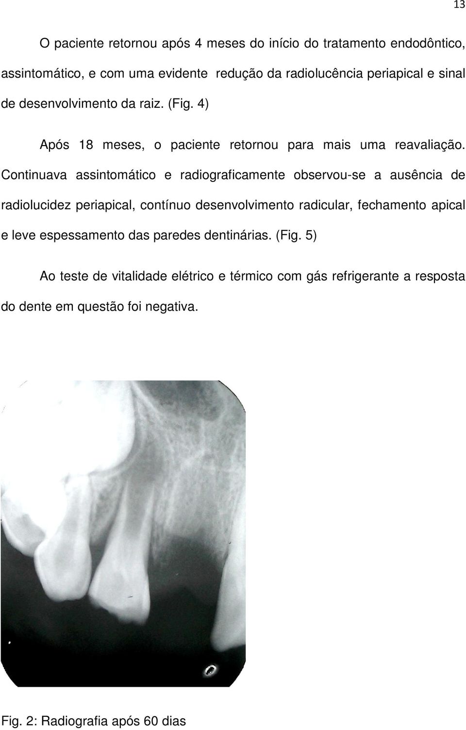 Continuava assintomático e radiograficamente observou-se a ausência de radiolucidez periapical, contínuo desenvolvimento radicular, fechamento