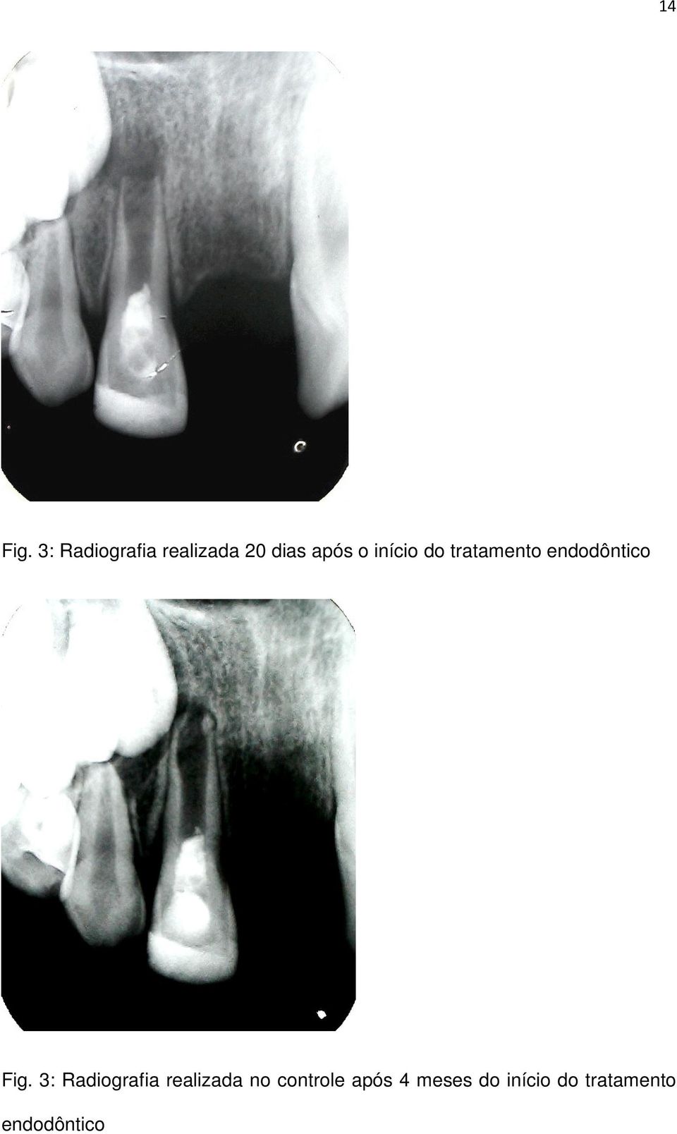 início do tratamento endodôntico Fig.