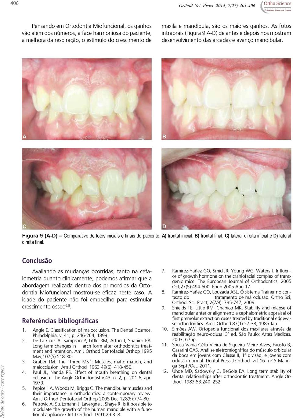 s fotos intraorais (Figura 9 -D) de antes e depois nos mostram desenvolvimento das arcadas e avanço mandibular.