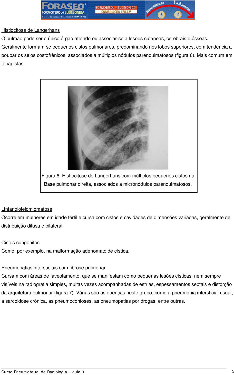 Mais comum em tabagistas. Figura 6. Histiocitose de Langerhans com múltiplos pequenos cistos na Base pulmonar direita, associados a micronódulos parenquimatosos.