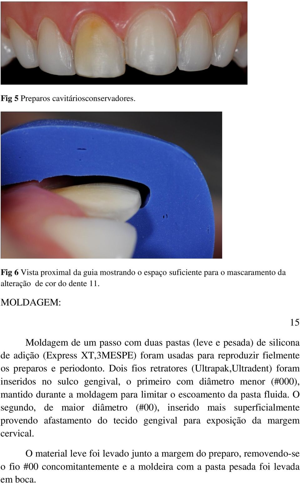 Dois fios retratores (Ultrapak,Ultradent) foram inseridos no sulco gengival, o primeiro com diâmetro menor (#000), mantido durante a moldagem para limitar o escoamento da pasta fluida.