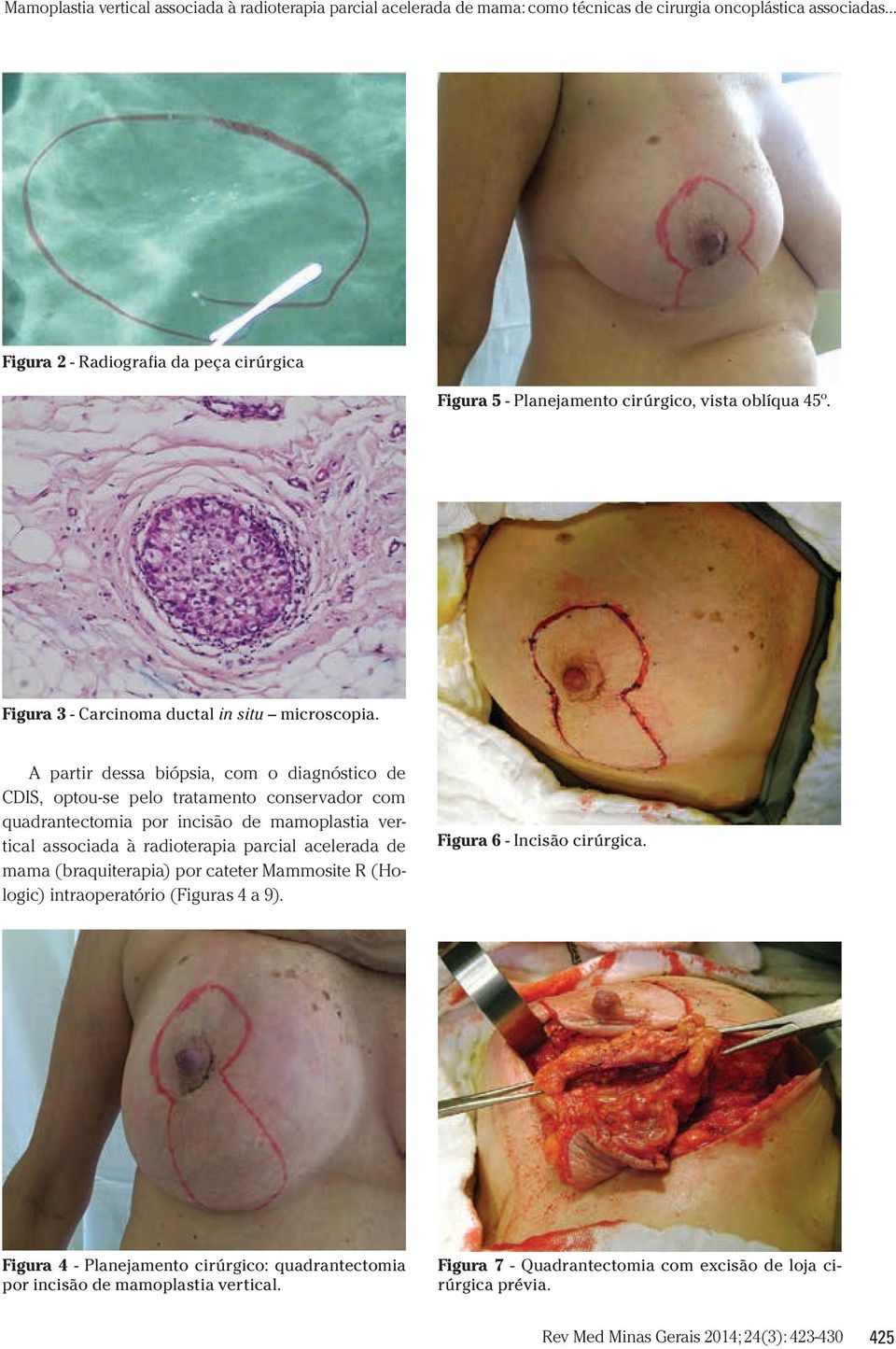 radioterapia parcial acelerada de mama (braquiterapia) por cateter Mammosite R (Hologic) intraoperatório (Figuras 4 a 9). Figura 6 - Incisão cirúrgica.
