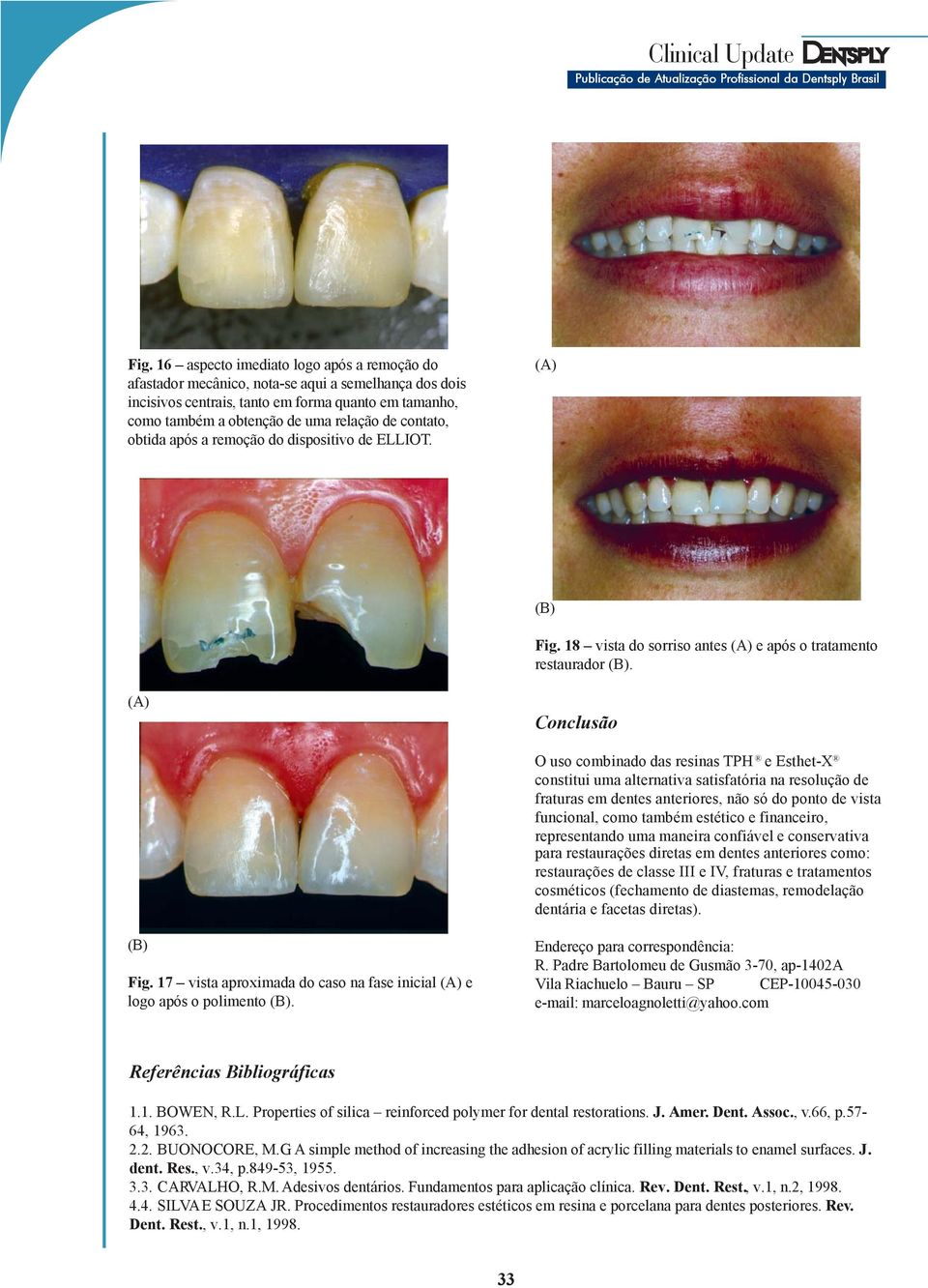 Conclusão O uso combinado das resinas TPH e Esthet-X constitui uma alternativa satisfatória na resolução de fraturas em dentes anteriores, não só do ponto de vista funcional, como também estético e