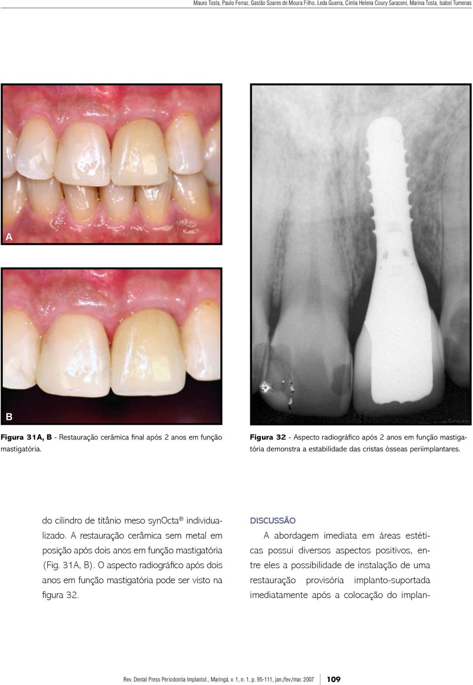 A restauração cerâmica sem metal em posição após dois anos em função mastigatória (Fig. 31A, B). O aspecto radiográfico após dois anos em função mastigatória pode ser visto na figura 32.