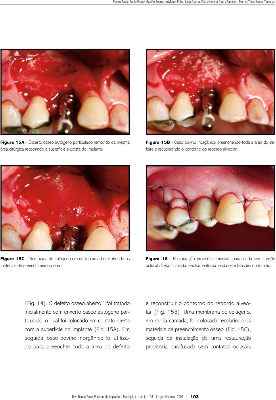 Figura 15C - Membrana de colágeno em dupla camada recobrindo os materiais de preenchimento ósseo. Figura 16 - Restauração provisória imediata parafusada sem função oclusal direta instalada.