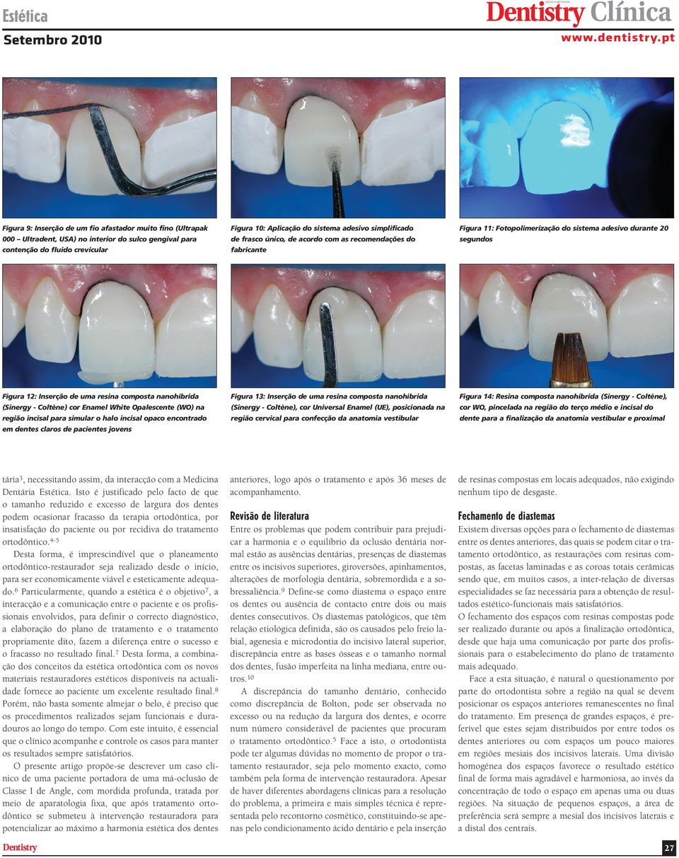 13: Inserção de uma resina composta nanohíbrida Figura 14: Resina composta nanohíbrida (Sinergy - Coltène), (Sinergy - Coltène) cor Enamel White Opalescente (WO) na (Sinergy - Coltène), cor Universal