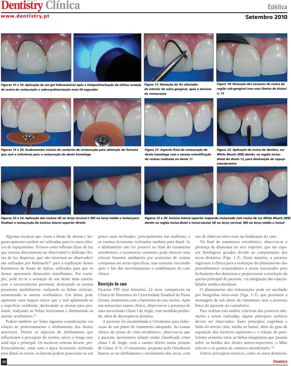 12 Figuras 19 e 20: Acabamentos iniciais do contorno da restauração para obtenção do formato Figura 21: Aspecto final da restauração do Figura 22: Aplicação da resina de dentina, cor que será a