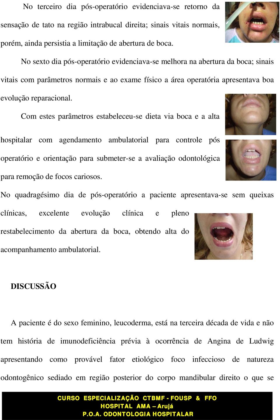 Com estes parâmetros estabeleceu-se dieta via boca e a alta hospitalar com agendamento ambulatorial para controle pós operatório e orientação para submeter-se a avaliação odontológica para remoção de