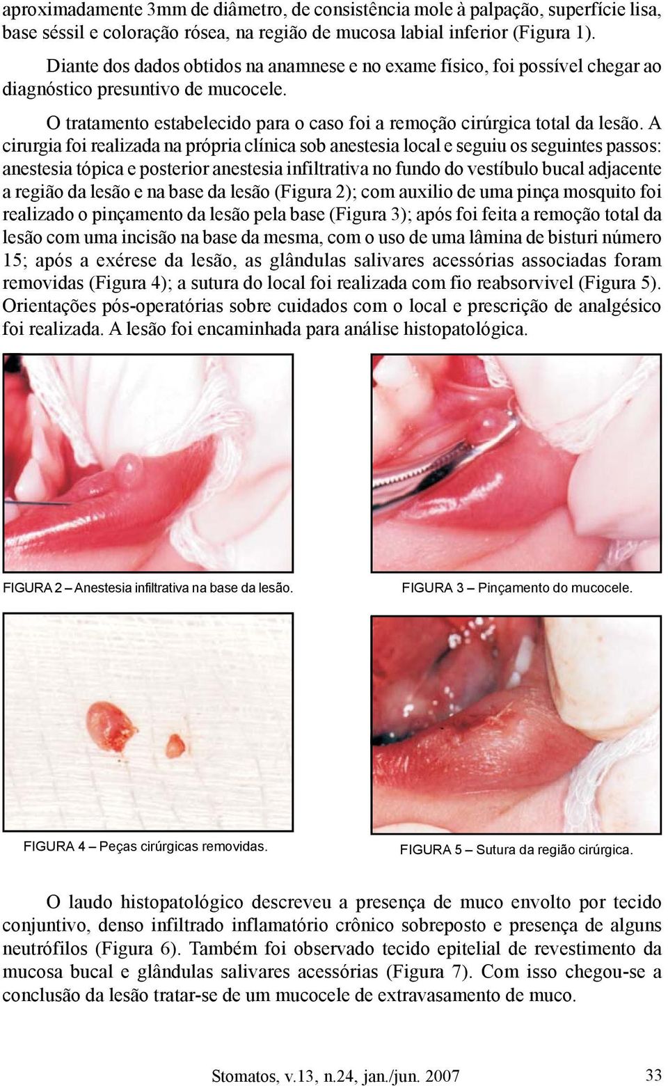 A cirurgia foi realizada na própria clínica sob anestesia local e seguiu os seguintes passos: anestesia tópica e posterior anestesia infiltrativa no fundo do vestíbulo bucal adjacente a região da