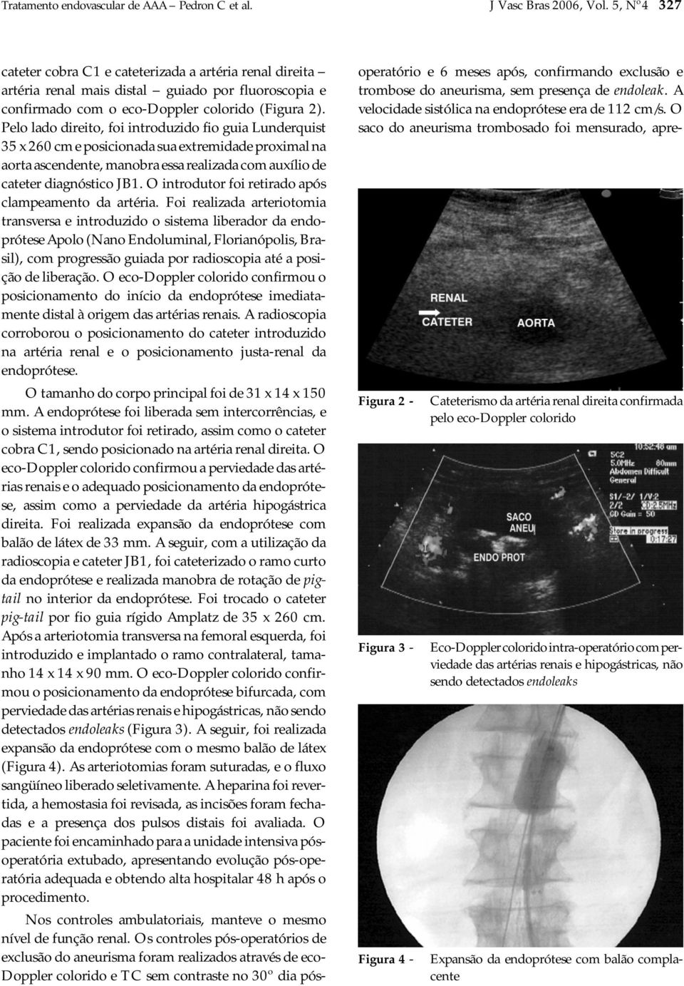 Pelo lado direito, foi introduzido fio guia Lunderquist 35 x 260 cm e posicionada sua extremidade proximal na aorta ascendente, manobra essa realizada com auxílio de cateter diagnóstico JB1.