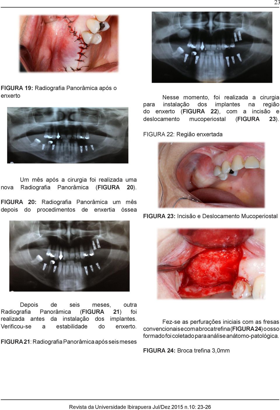 FIGURA 20: Radiografia Panorâmica um mês depois do procedimentos de enxertia óssea FIGURA 23: Incisão e Deslocamento Mucoperiostal Depois de seis meses, outra Radiografia Panorâmica (FIGURA 21) foi