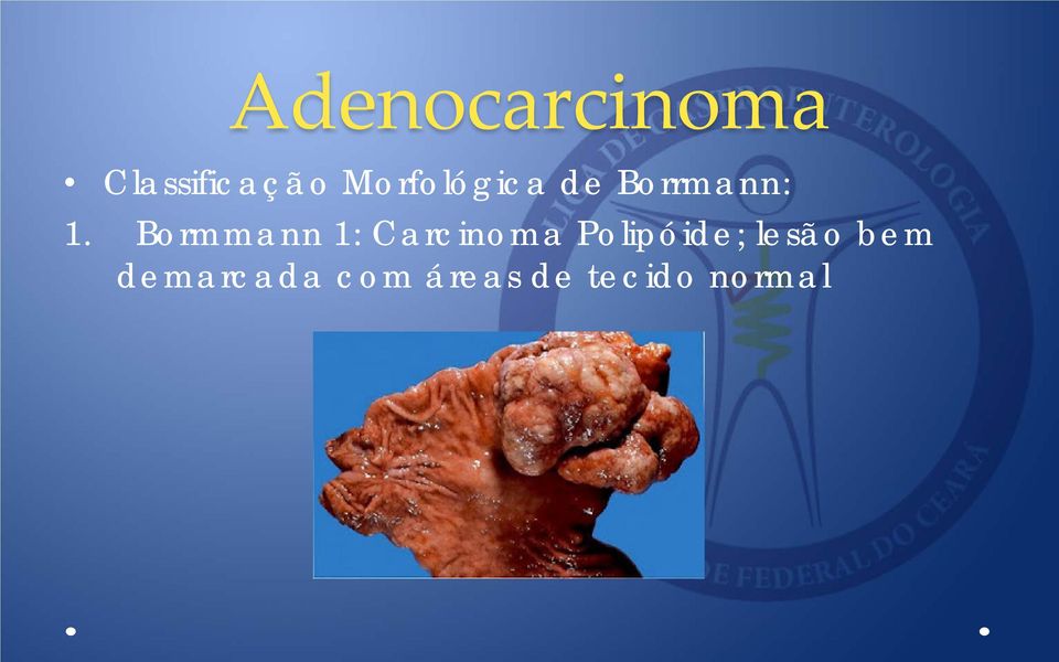 Bormmann 1: Carcinoma Polipóide;