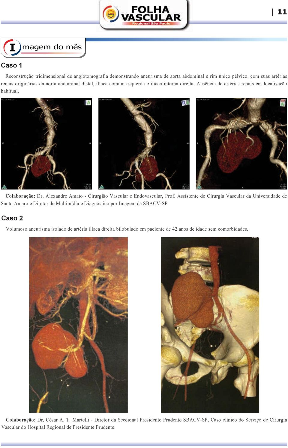 Assistente de Cirurgia Vascular da Universidade de Santo Amaro e Diretor de Multimídia e Diagnóstico por Imagem da SBACV-SP Caso 2 Volumoso aneurisma isolado de artéria ilíaca direita bilobulado em