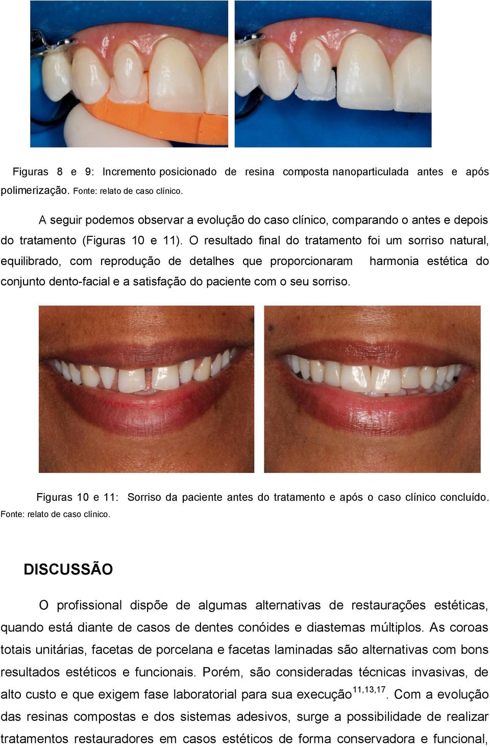 O resultado final do tratamento foi um sorriso natural, equilibrado, com reprodução de detalhes que proporcionaram harmonia estética do conjunto dento-facial e a satisfação do paciente com o seu