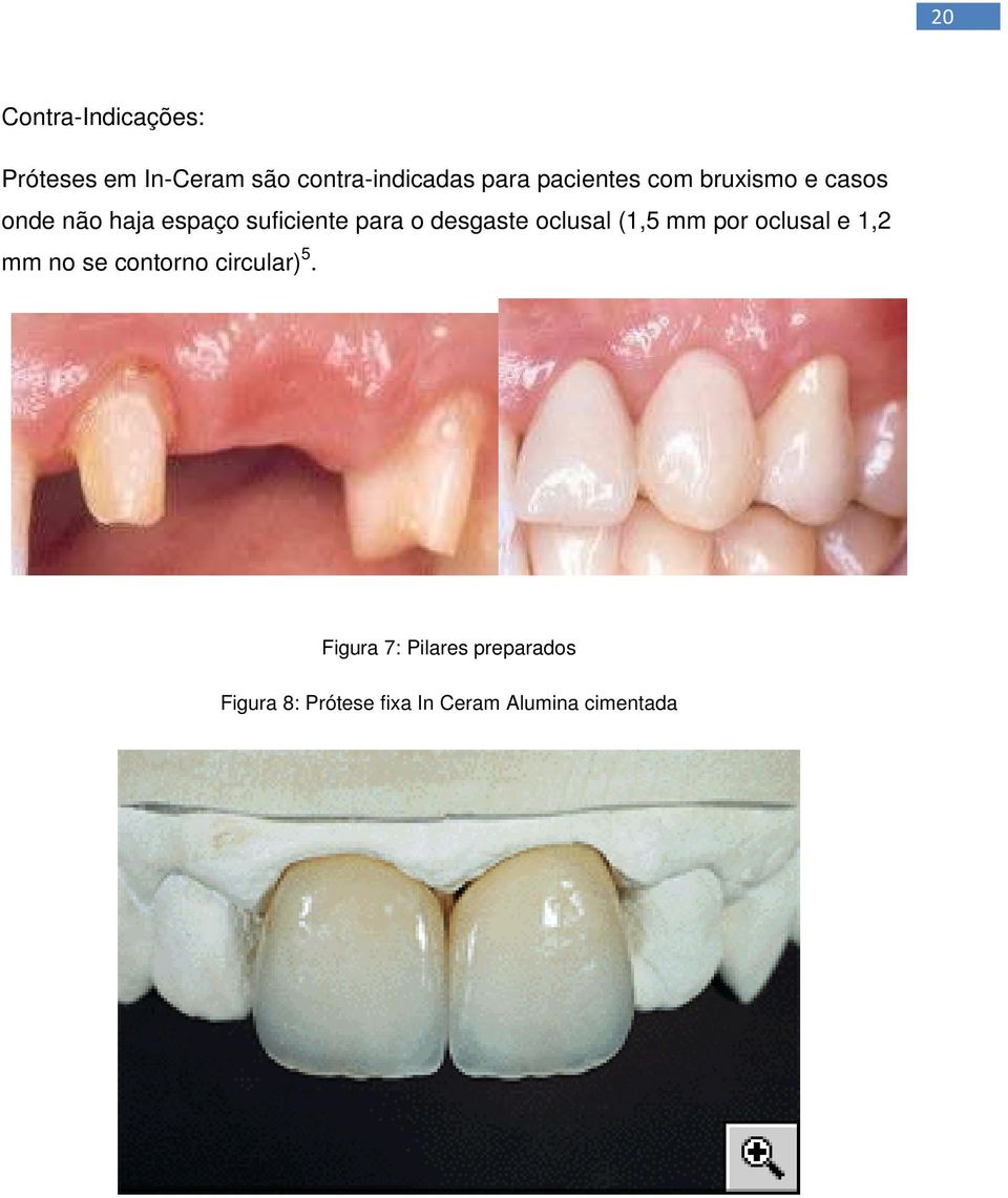 desgaste oclusal (1,5 mm por oclusal e 1,2 mm no se contorno circular) 5.