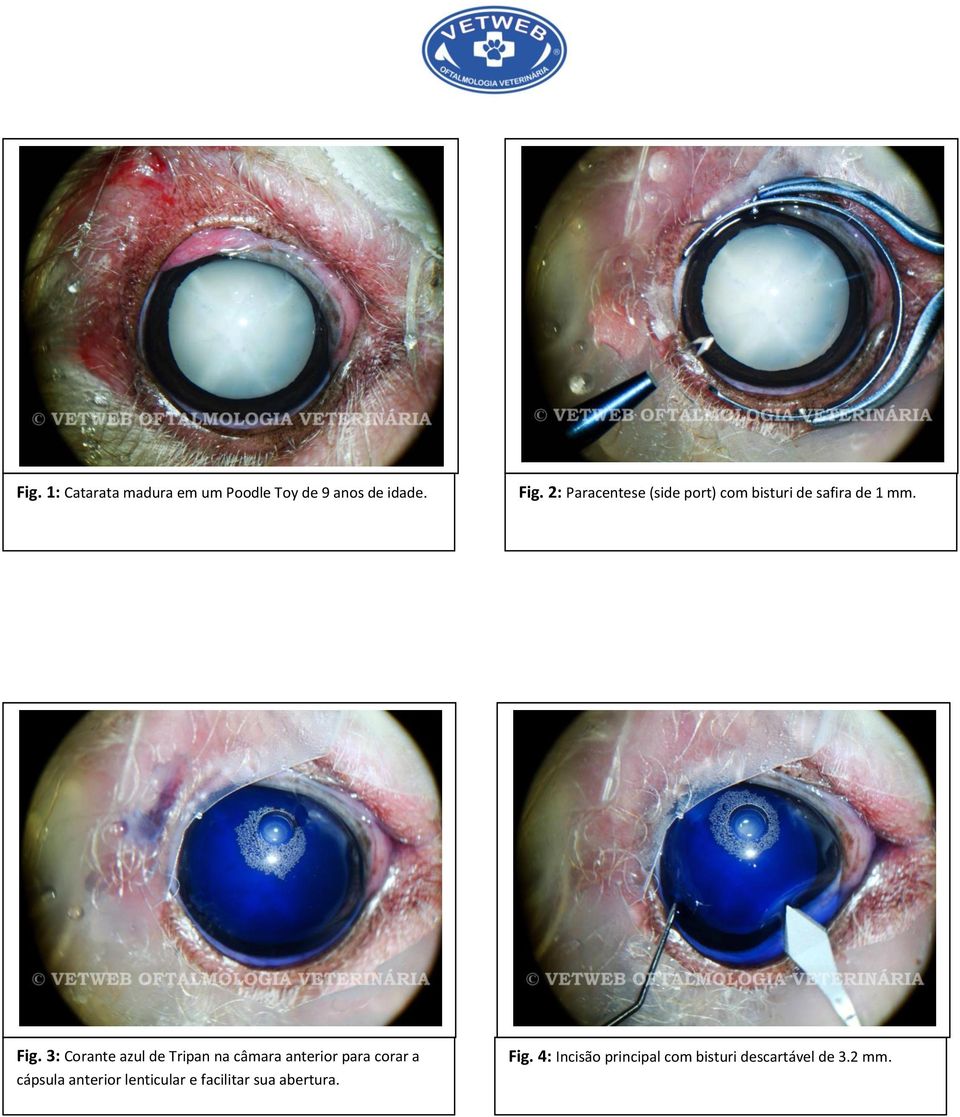 3: Corante azul de Tripan na câmara anterior para corar a cápsula anterior