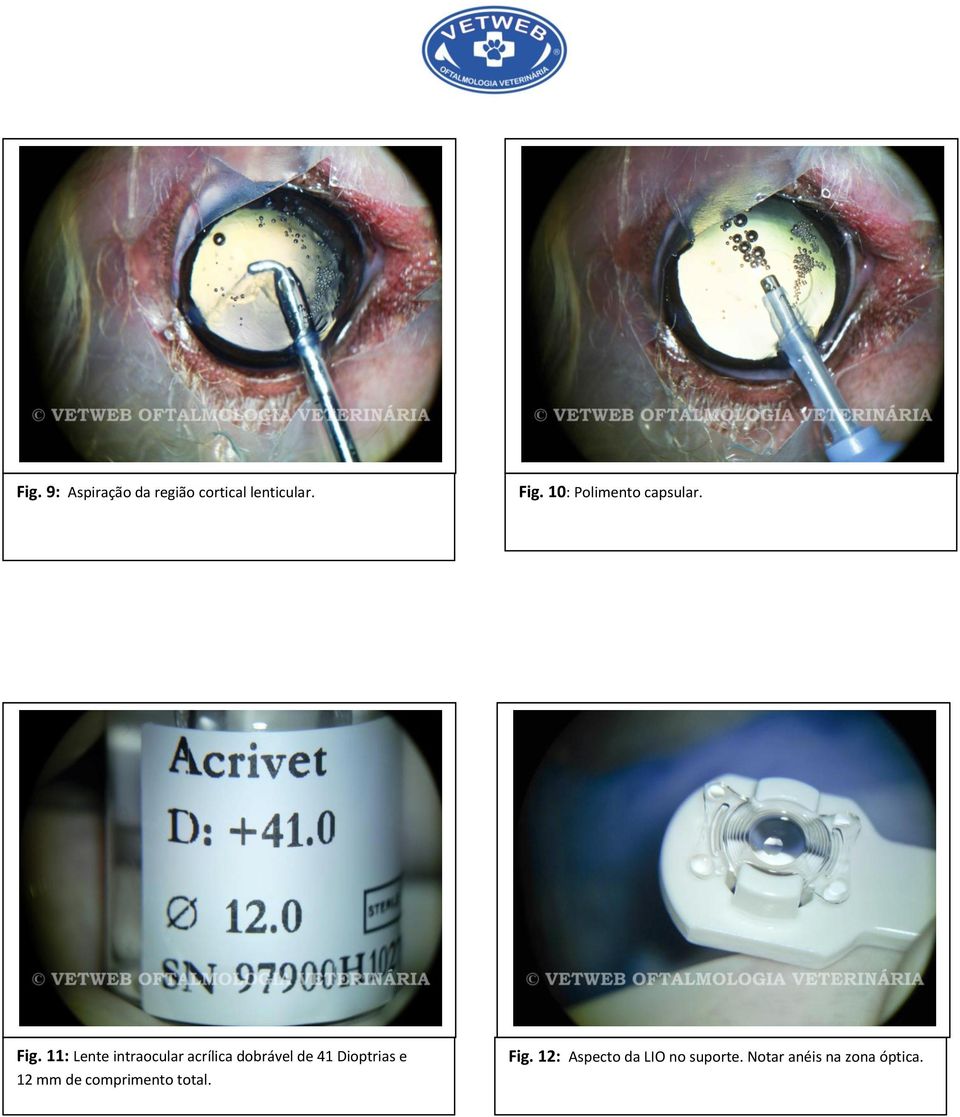 11: Lente intraocular acrílica dobrável de 41 Dioptrias e