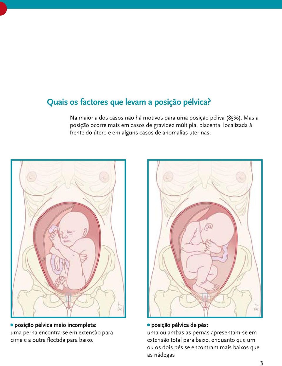 uterinas. posição pélvica meio incompleta: uma perna encontra-se em extensão para cima e a outra flectida para baixo.