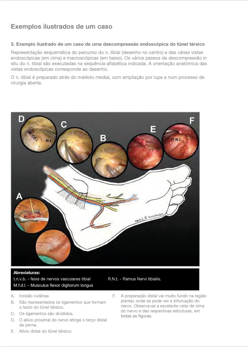 tibial são executadas na sequência alfabética indicada. A orientação anatómica das vistas endoscópicas corresponde ao desenho. O n.