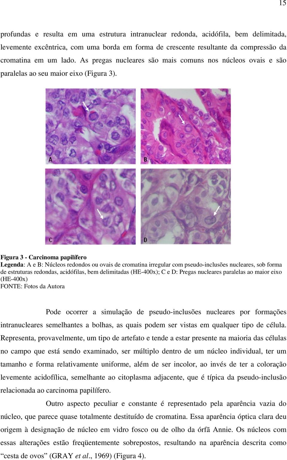 Figura 3 - Carcinoma papilífero Legenda: A e B: Núcleos redondos ou ovais de cromatina irregular com pseudo-inclusões nucleares, sob forma de estruturas redondas, acidófilas, bem delimitadas