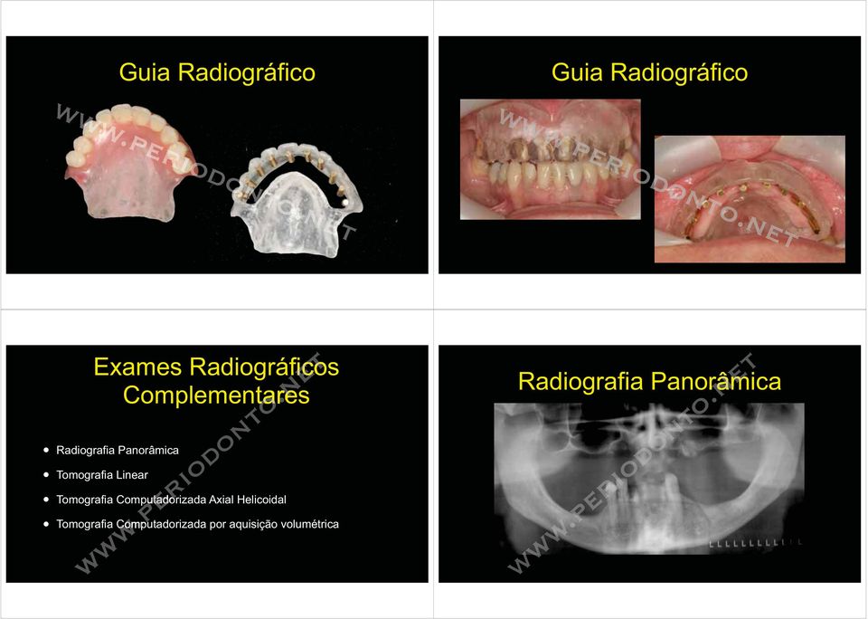 Tomografia Computadorizada Axial Helicoidal Tomografia