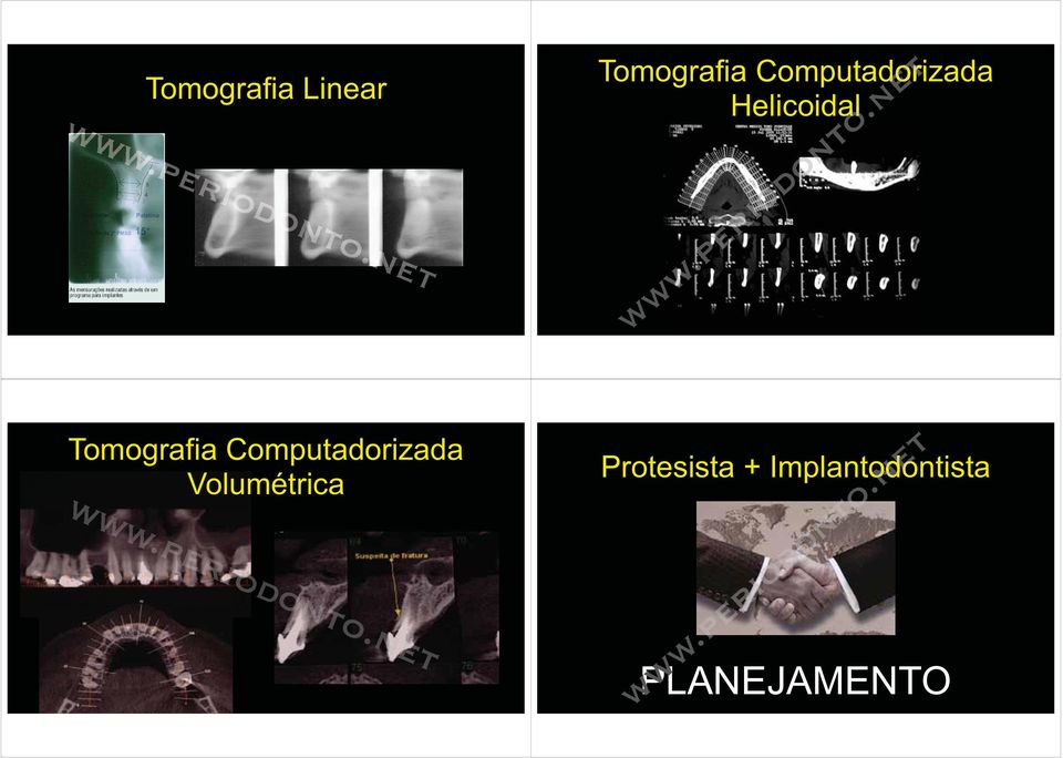 Tomografia Computadorizada