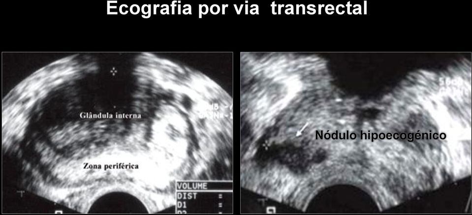 transrectal