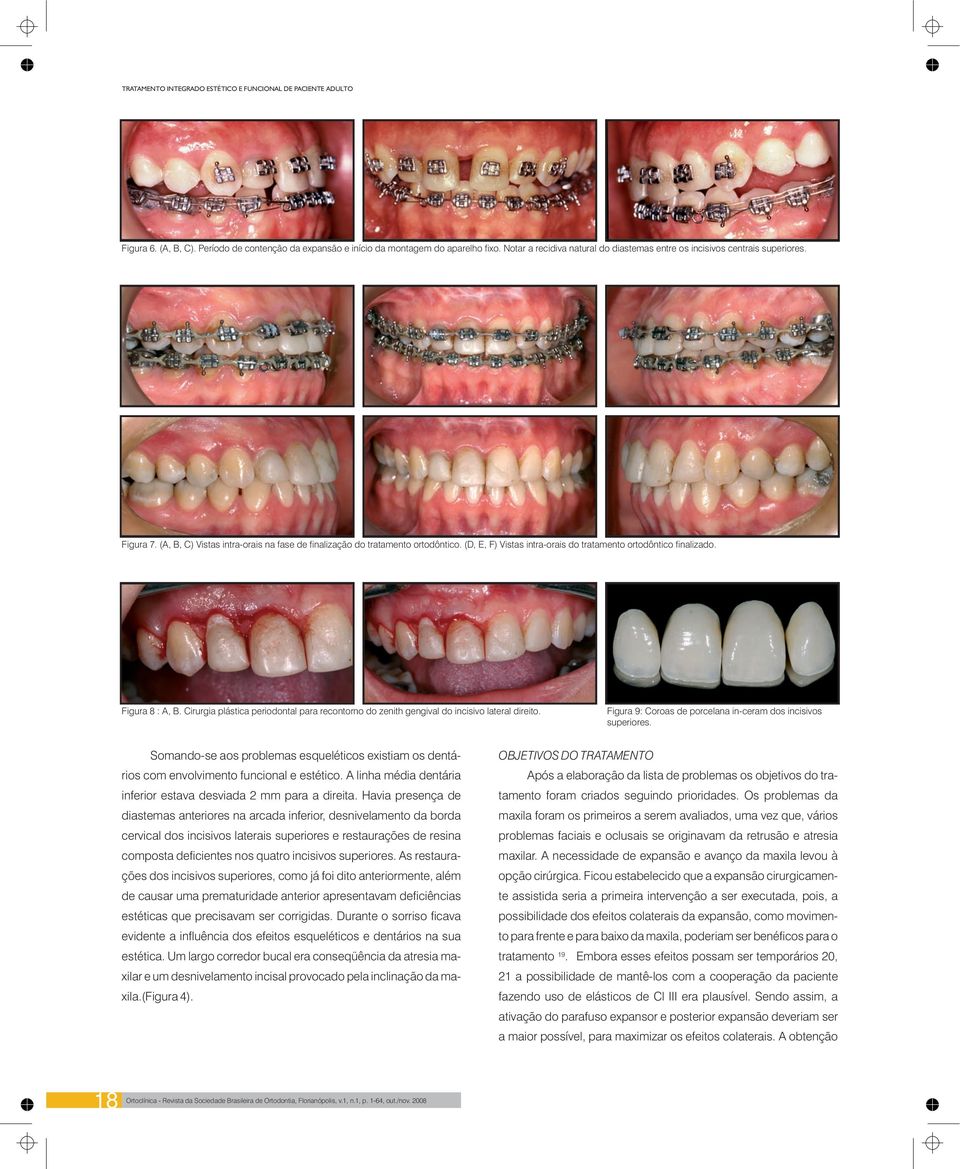 (D, E, F) Vistas intra-orais do tratamento ortodôntico finalizado. Figura 8: A, B. Cirurgia plástica periodontal para recontorno do zenith gengival do incisivo lateral direito.