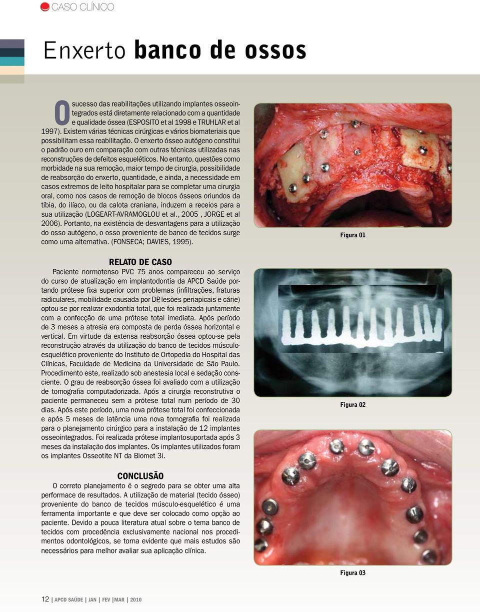 O enxerto ósseo autógeno constitui o padrão ouro em comparação com outras técnicas utilizadas nas reconstruções de defeitos esqueléticos.