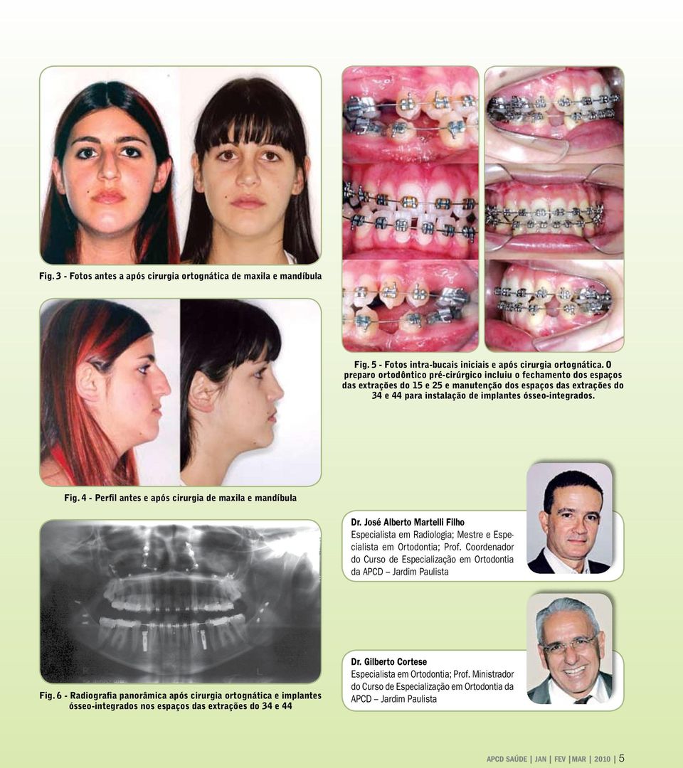 4 - Perfil antes e após cirurgia de maxila e mandíbula Dr. José Alberto Martelli Filho Especialista em Radiologia; Mestre e Especialista em Ortodontia; Prof.