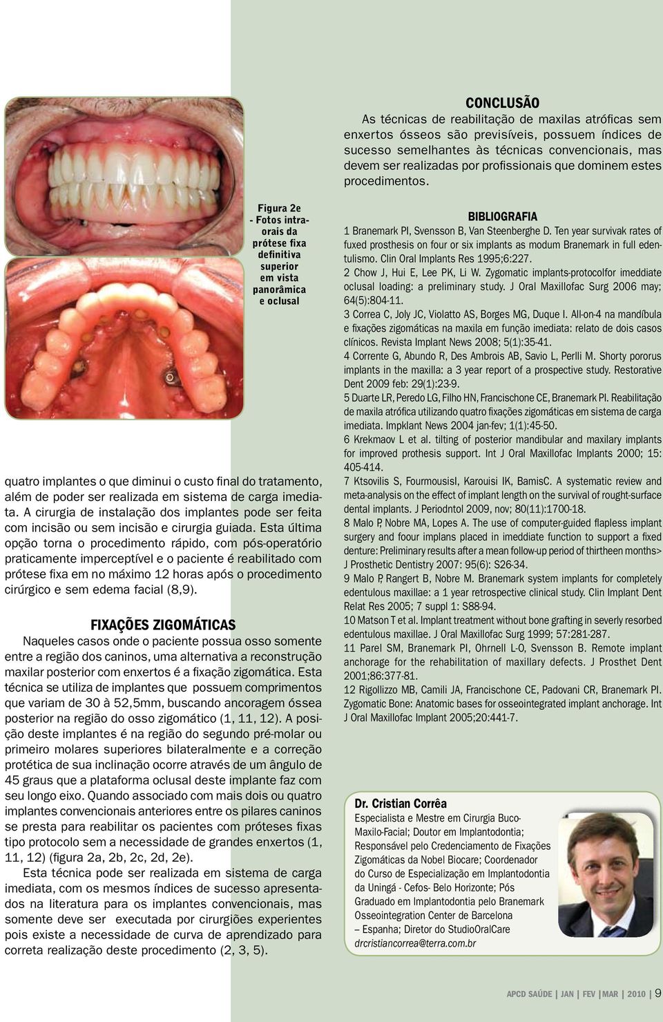 Figura 2e - Fotos intraorais da prótese fixa definitiva superior em vista panorâmica e oclusal quatro implantes o que diminui o custo final do tratamento, além de poder ser realizada em sistema de