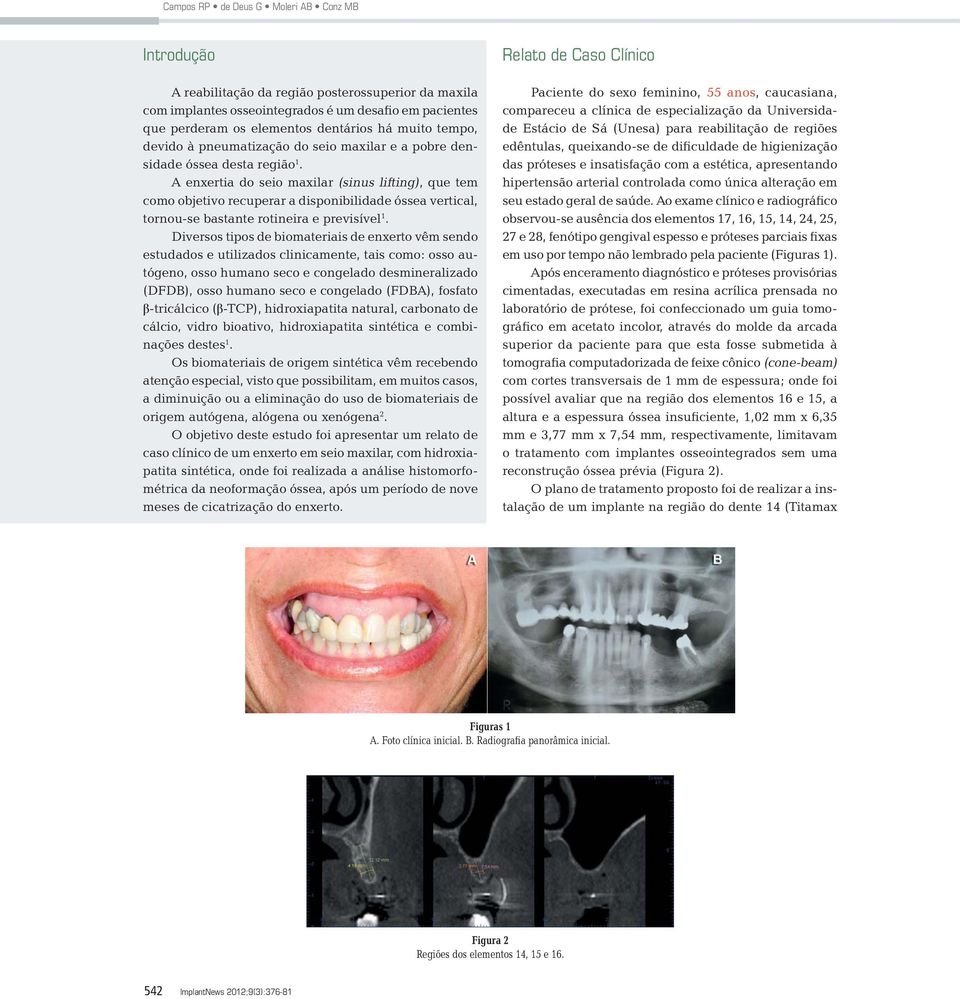 A enxertia do seio maxilar (sinus lifting), que tem como objetivo recuperar a disponibilidade óssea vertical, tornou-se bastante rotineira e previsível 1.