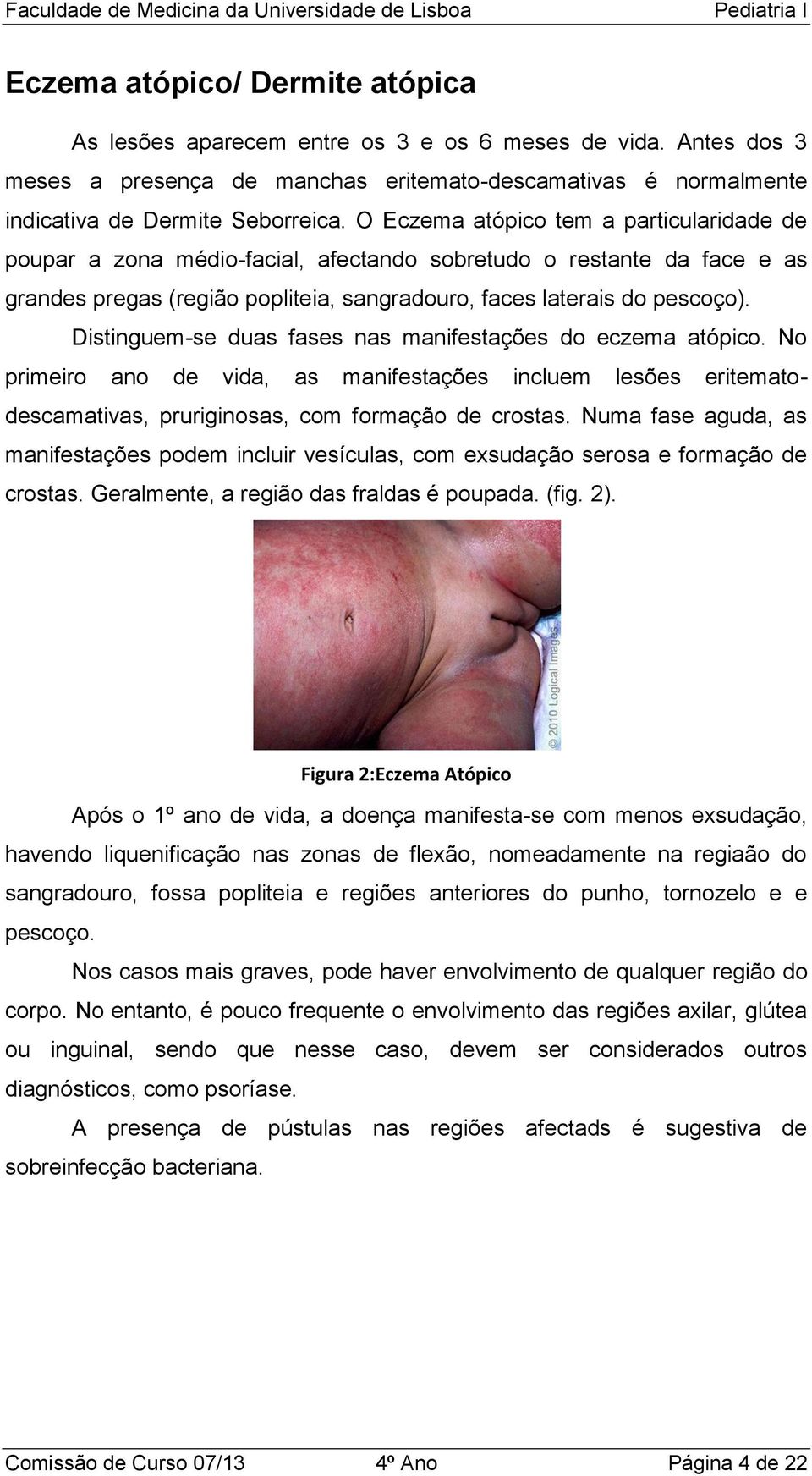 O Eczema atópico tem a particularidade de poupar a zona médio-facial, afectando sobretudo o restante da face e as grandes pregas (região popliteia, sangradouro, faces laterais do pescoço).