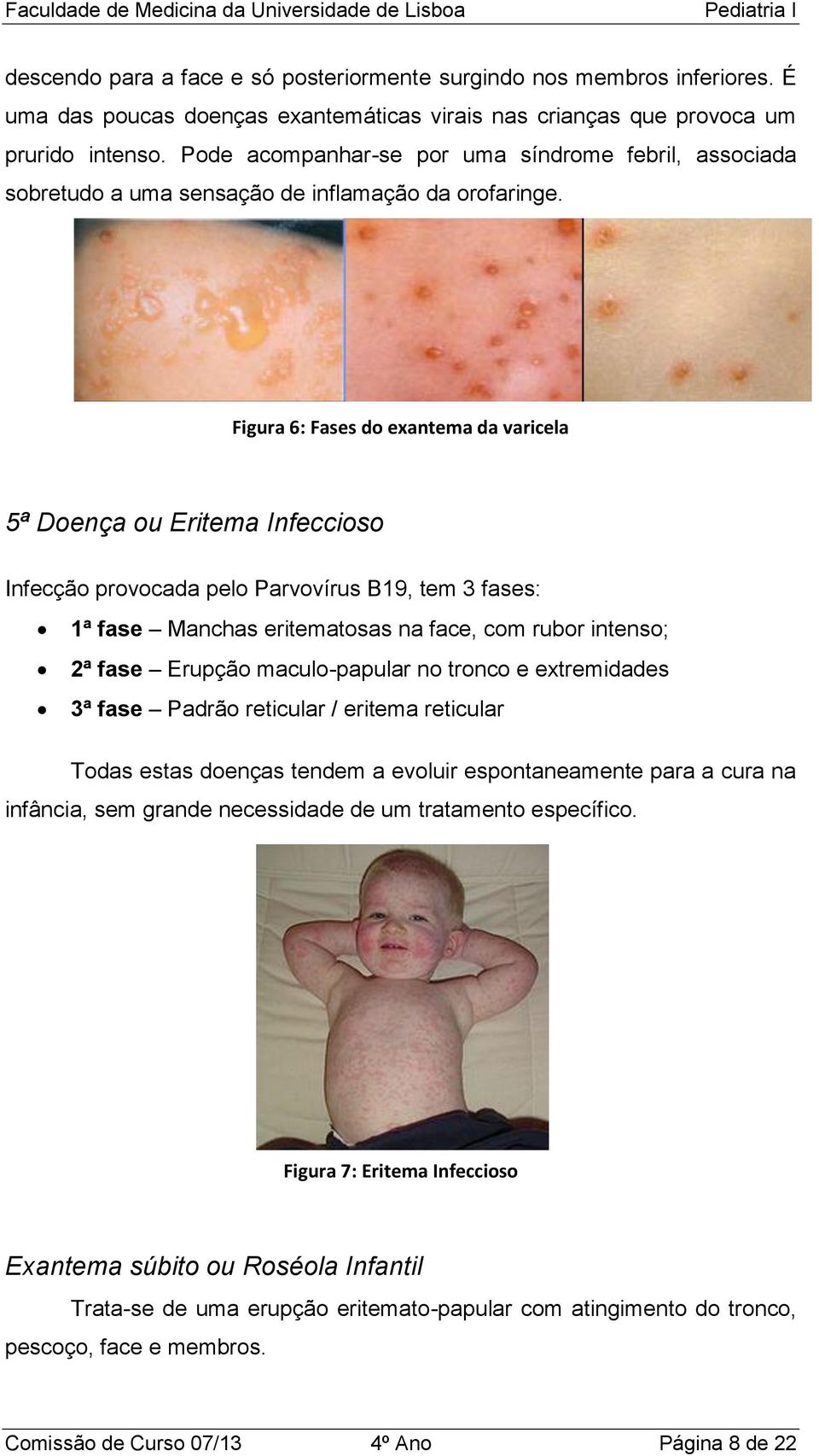 Figura 6: Fases do exantema da varicela 5ª Doença ou Eritema Infeccioso Infecção provocada pelo Parvovírus B19, tem 3 fases: 1ª fase Manchas eritematosas na face, com rubor intenso; 2ª fase Erupção