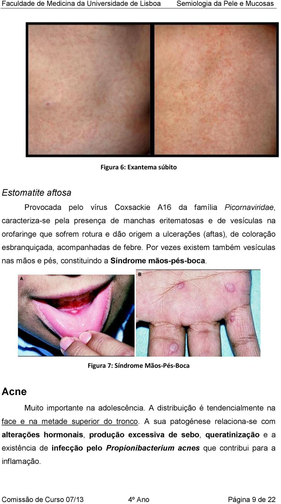 Por vezes existem também vesículas nas mãos e pés, constituindo a Síndrome mãos-pés-boca. Figura 7: Síndrome Mãos-Pés-Boca Acne Muito importante na adolescência.