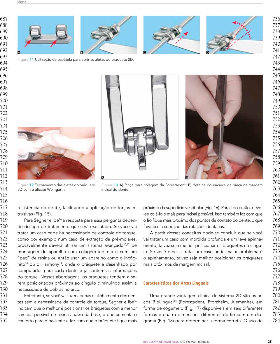 resistência do dente, facilitando a aplicação de forças intrusivas (Fig. 15). Para Segner e Ibe 16 a resposta para essa pergunta depende do tipo de tratamento que será executado.